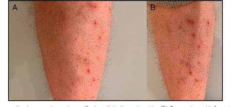 Figure 1 From Acrodermatitis Enteropathica Associated With Inflammatory