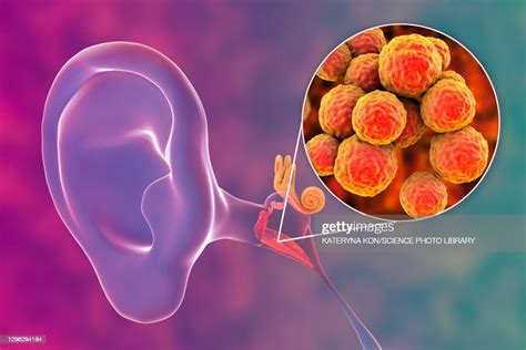 Otitis Media Ear Infection Illustration High Res Vector Graphic Getty