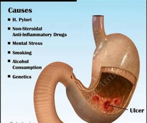 Diseases And Patient Care What Is Peptic Ulcer Disaese And What Are Preventive Measures