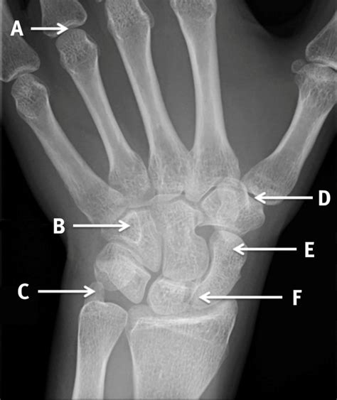 Scaphoid View Radiograph Of The Left Wrist The Bmj