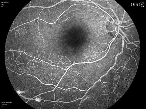 Marked Retinal Ischemia In Patient With Mixed Connective Tissue Disease