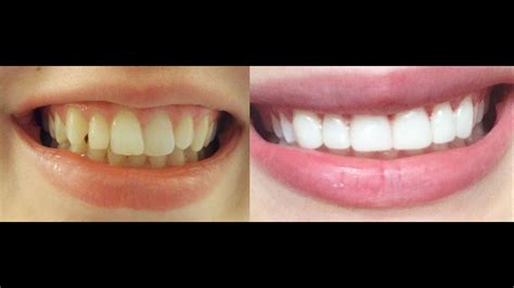 How To Naturally Straighten Front Teeth Teeth Bonding