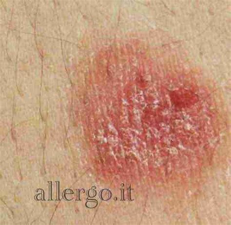 Dermatiti Immagini Allergie E Malattie Della Pelle
