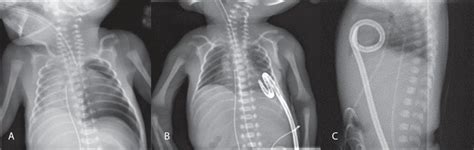 Pleuro Pericardial Communication Due To Pigtail Catheters In Extreme