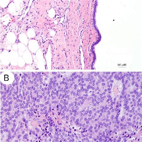 Small Cysts Are Lined By Benign Squamous And Columnar Epithelium With