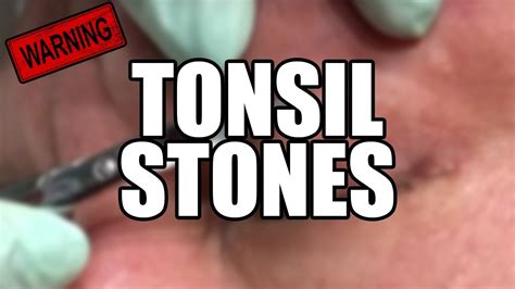 Epic Tonsil Stones And Tonsil Stone Removal Youtube