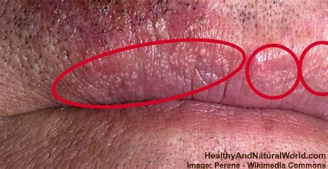 White Bumps On Lips Causes And Treatments