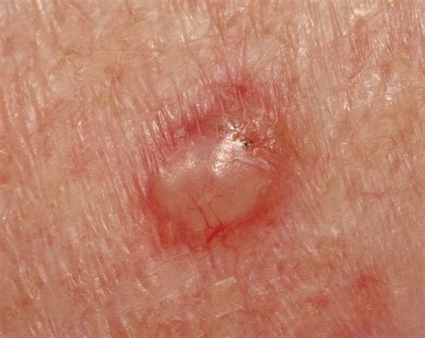 Basal Cell Carcinoma Removal Basal Cell Carcinoma Treatment