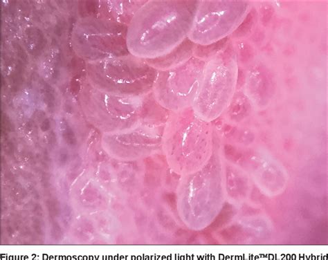 Figure From Importance Of Dermoscopy To Diagnose Vulvar Vestibular Papillomatosis Vs Warts