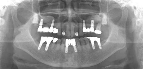 Panoramic Radiograph After Implant Placement Hiossen Implant Canada