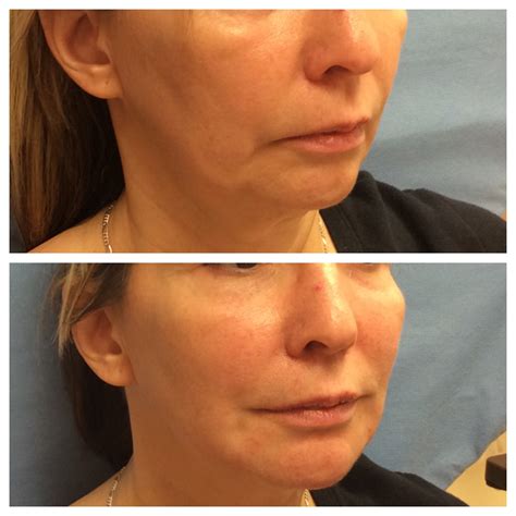 Radiesse® Before And After Photos Lisa Bunin Md