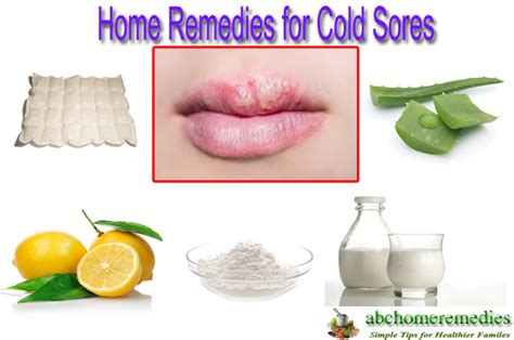 Home Remedies For Cold Sores