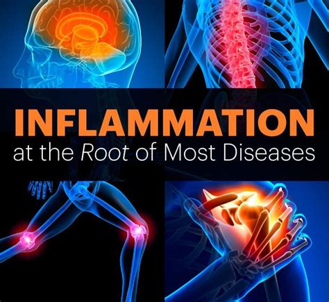 Natural Treatments For Inflammation Top 19 Home Remedies