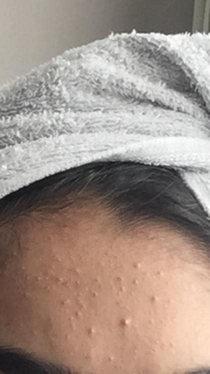 Little Acne Bumps On Forehead General Acne Discussion Forum