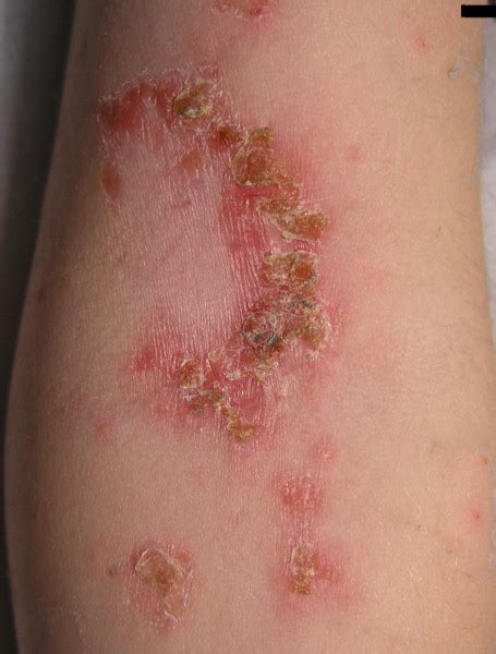 Impetigine In Bambini E Adulti Foto Sintomi Cause E Terapia Valori