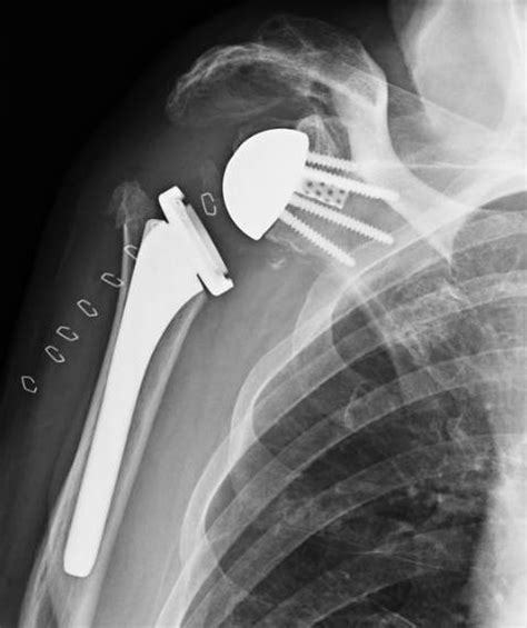 Shoulder And Elbow Surgery Dislocation Of Reverse Shoulder Replacement