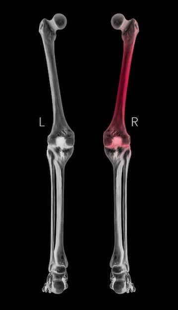 Premium Photo X Ray Human Leg Bone Posterior View With Red Highlights