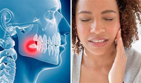 Wisdom Tooth Eruption Can Lead To Pericoronitis Dentist On How To