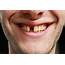 Provide Stable Functionality For Missing Teeth  Prestige Oral Surgery