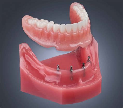 Shatkin Mini Dental Implants Dr Todd E Shatkin Aesthetic Associates