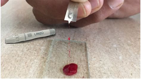 Blood Clotting Time Determination By Slide Method Blood Clotting Time