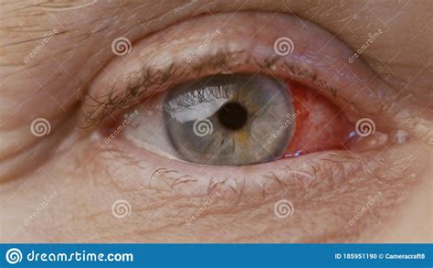 Close Up Woman Eye With Chemical Burns Of The Cornea Stock Photo