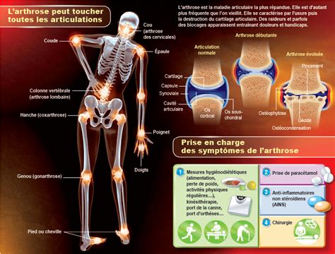 Haute Autorité De Santé Arthrose Le Paracétamol En 1re Intention Lors Des Crises Douloureuses