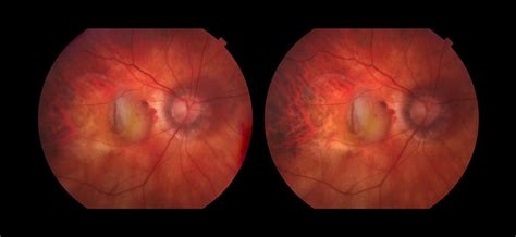 Wet Age Related Macular Degeneration Photograph By Paul Whitten