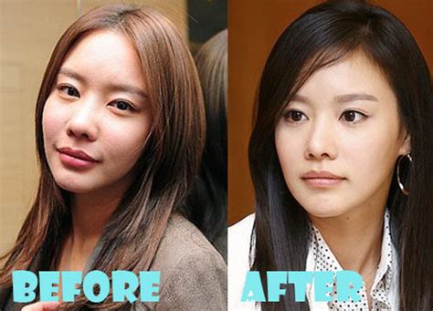 Kim Ah Joong Plastic Surgery Before And After Photos Lovely Surgery