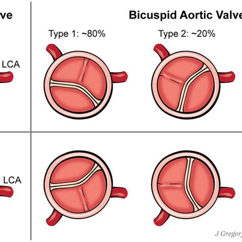 Anatomical Classification For Bicuspid Aortic Valves Abbreviations Download Scientific