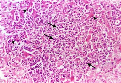Focal Coagulative Necrosis Of Hepatocytes Infiltrated With Mononuclear