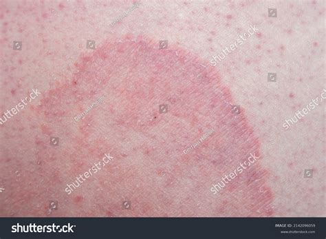 Tinea Cruris Known Jock Itch Common Foto Stock 2142096059 Shutterstock