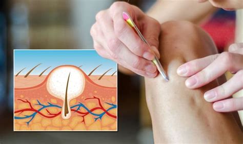 Ingrown Hair Removal How To Get Rid Of Ingrown Hairs Expert Recommends Treatment Uk