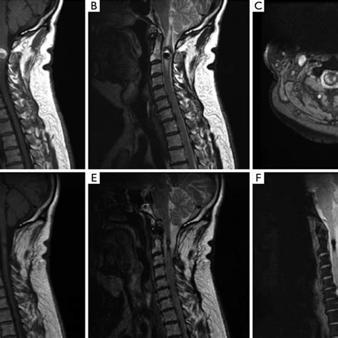 Preoperative Sagittal T1 Weighted A And T2 Weighted B Magnetic