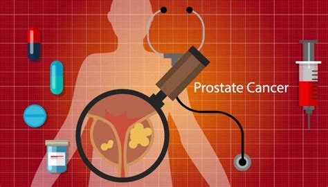 Kanker Prostat Gejala Penyebab Diagnosis Dan Pengobatan