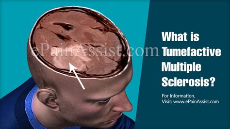 Tumefactive Multiple Sclerosiscausessymptoms Treatmentdiagnosis