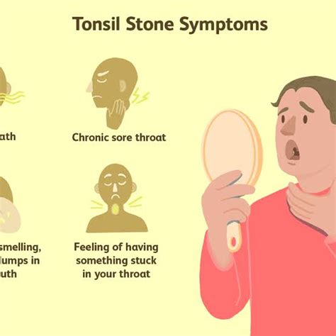 Tonsil Stones Symptoms And Treatment