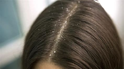 7 Penyebab Ketombe Parah yang Harus Kamu Waspadai, Jangan ...