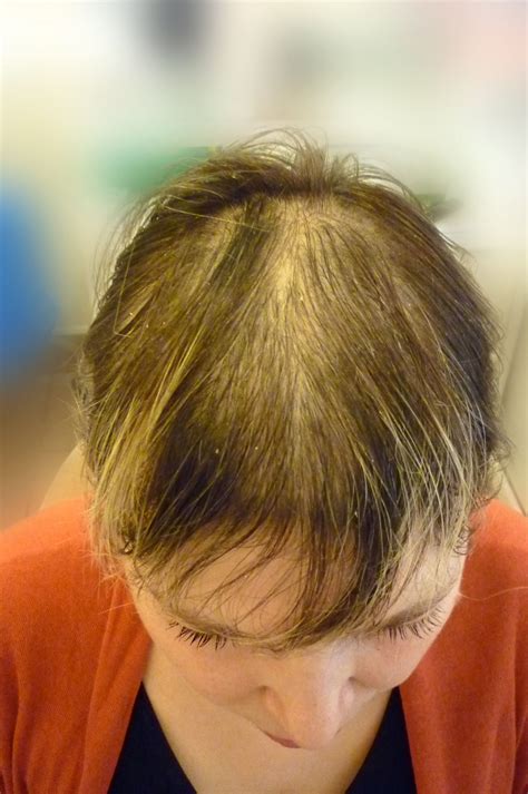Alopecia Areata Hair Regrowth Spefashion