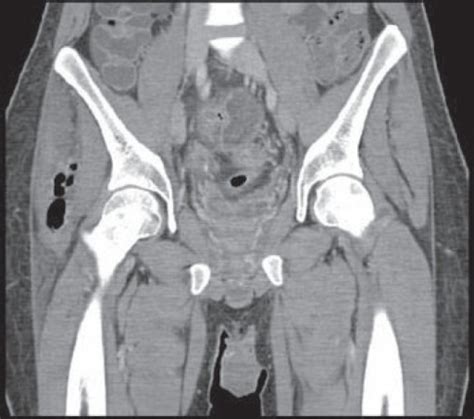 CT Scans Of The Abdomen And Pelvis Coronal Section Open I