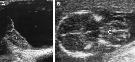 Cephalocele A Left Frontal Sagittal Neurosonogram In A Newborn With