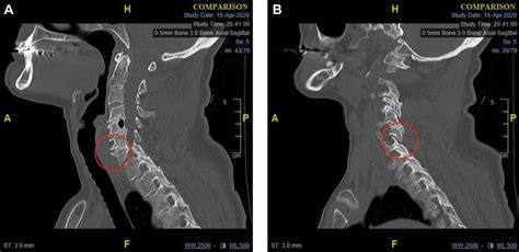 A Para Midline Sagittal Ct Scan Of The Cervical Spine At The Time Of