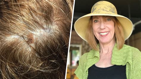 Skin Cancer In Hair
