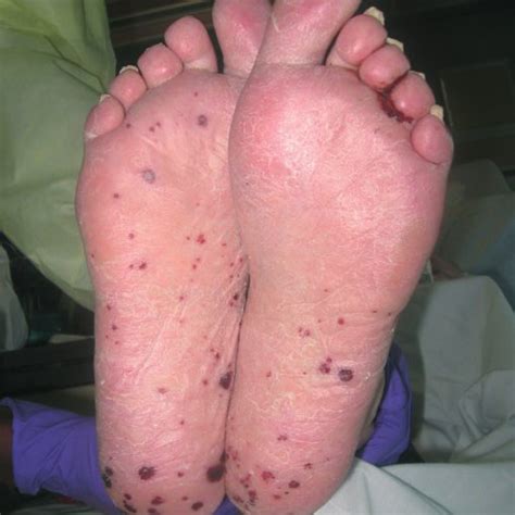 Maculopapular Vasculitic Skin Rash Involving The Soles Of The Feet
