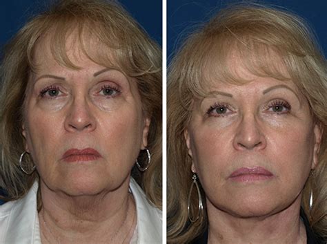 Fat Transfer Before And After Photos San Diego David And Rossi Cosmetic