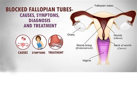 Fallopian Tube Blockage