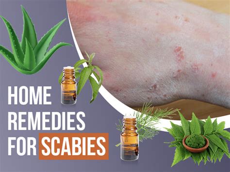 9 Home Remedies That Can Help Treat Scabies