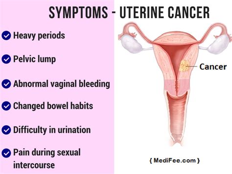 Endometrial Cancer Types Symptoms Diagnosis And Prevention