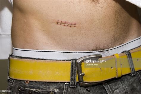 Fresh Scar From Removal Of Appendix High Res Stock Photo Getty Images