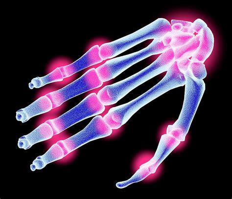 Arthritic Hand Bones Photograph By Alfred Pasiekascience Photo Library